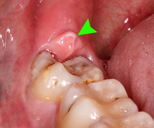 Diş Enfeksiyonu