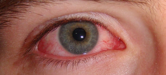 Göz Enfeksiyonu Belirtileri